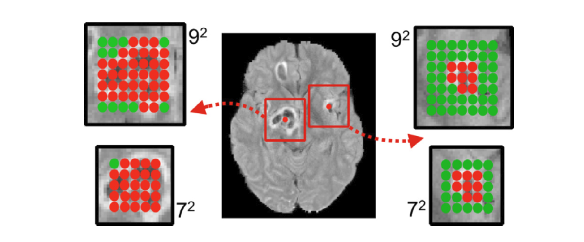 Fig.3. Consider a network with a 2D receptive field of $3^2$ (for illustration) densely-applied on the depicted lesion-centred image segments of size $7^2$ or $9^2$. Relatively more background (green) is captured by larger segments and around smaller lesions. (For interpretation of the references to colour, the reader is referred to the web version of this article.)